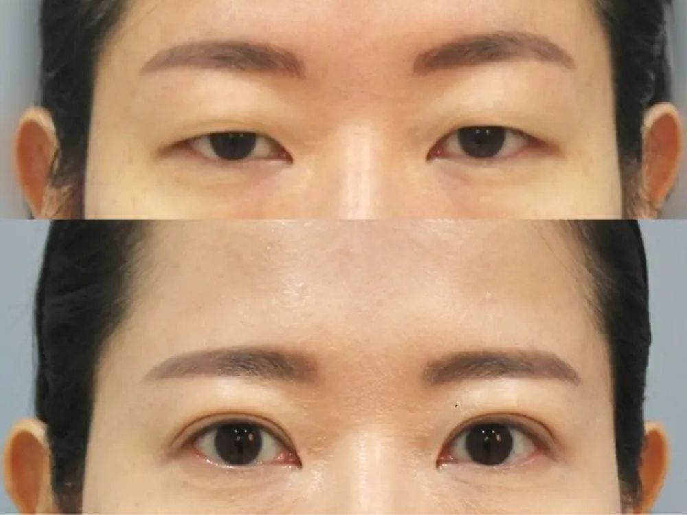 Imagem mostra a diferença nos olhos de uma sul coreana após cirurgia de pálpebra